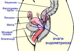 Endometriozis: Halk ilaçları ile tedavi