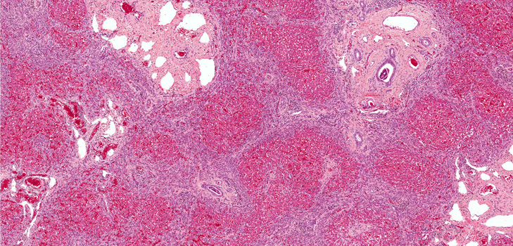 Fibroz nedir? Semptomlar, fotoğraflar ve tedavi