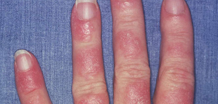 Lupus nedir? Hastalığın belirtileri ve nedenleri