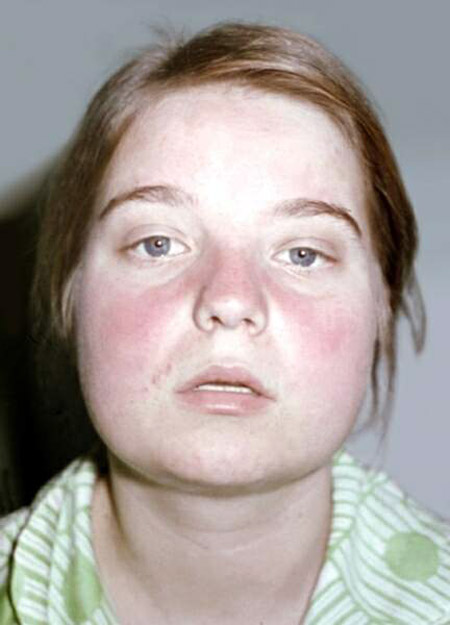 Lupus nedir? Hastalığın belirtileri ve nedenleri