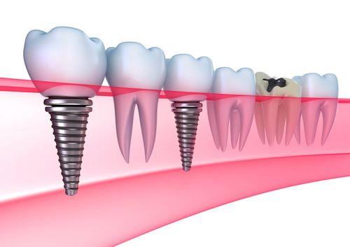 Diş implantasyonu lüks mü yoksa bir zorunluluk mu? 