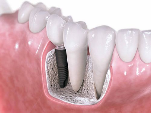 Diş implantasyonu lüks mü yoksa bir zorunluluk mu? 