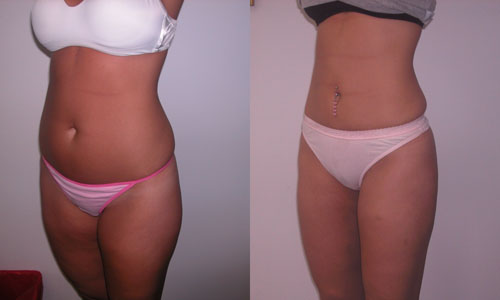 Karın ve kalçaların Liposuction: önce, sonra, yorum, fotoğraf