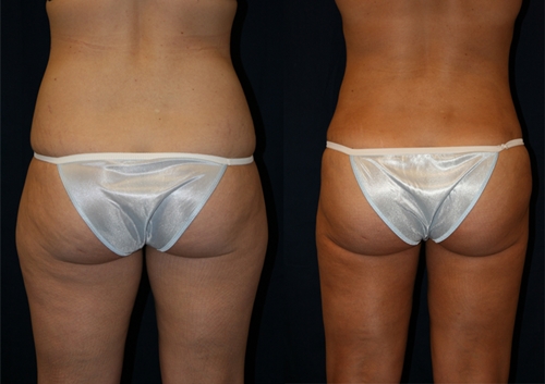 Karın ve kalçaların Liposuction: önce, sonra, yorum, fotoğraf