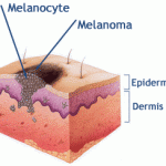 Cildin melanoması
