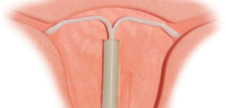 Nullipar kadınlara intrauterin bir cihaz koymak mümkün mü