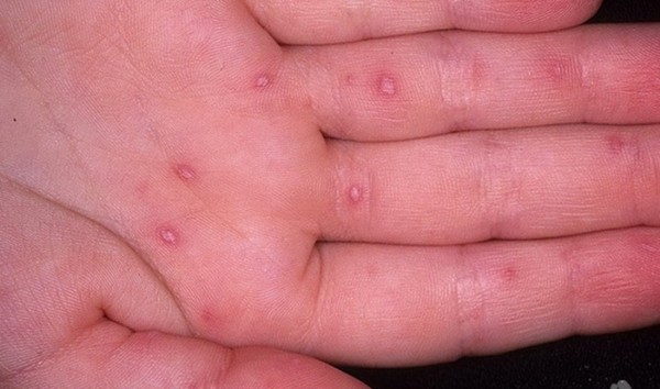Yetişkinlerde döküntüler: fotoğraflar, döküntülerin nedenleri ve cildin kızarıklıklarının tedavisinde ipuçları